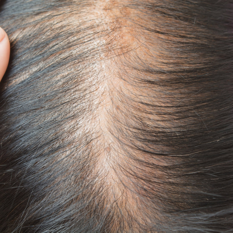 Recurring scalp concerns