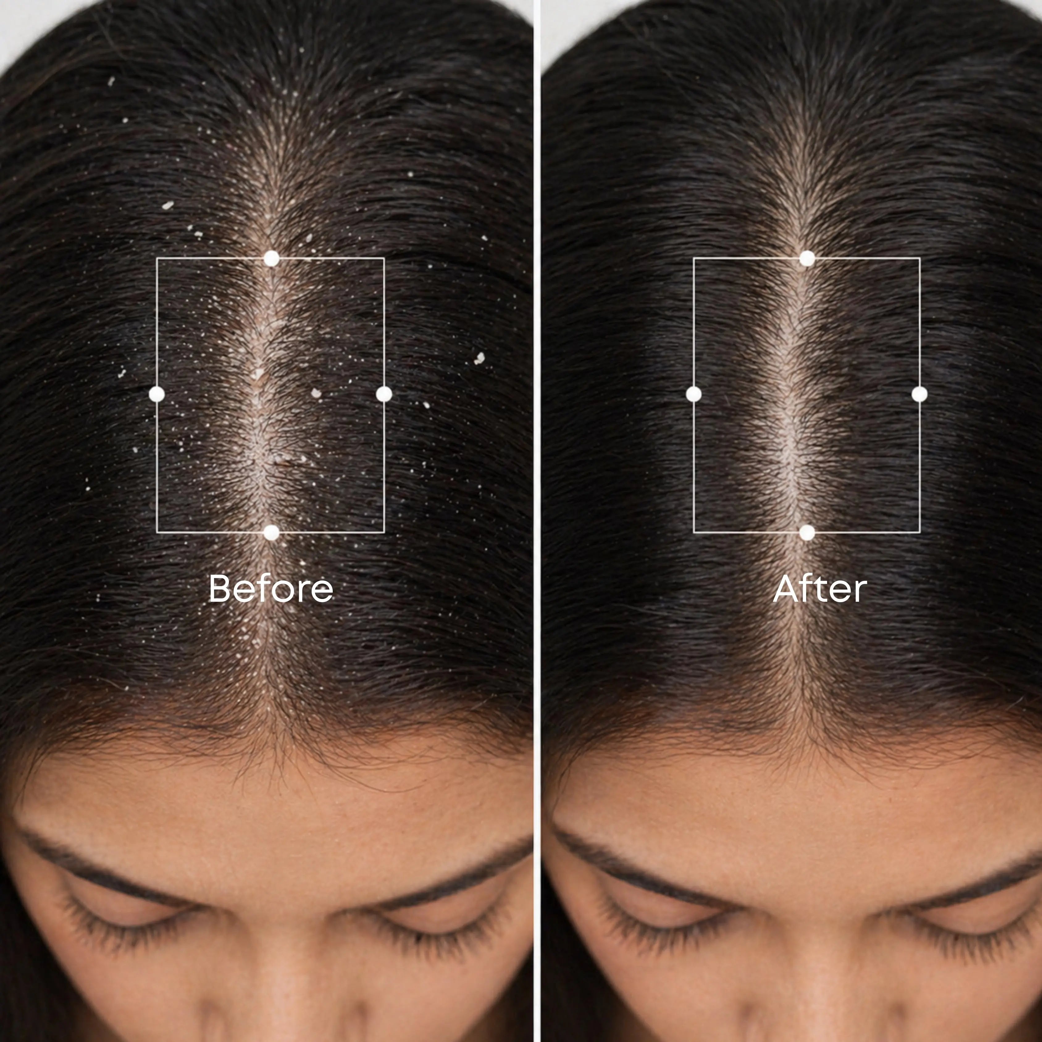 Flake Off - For Scalp